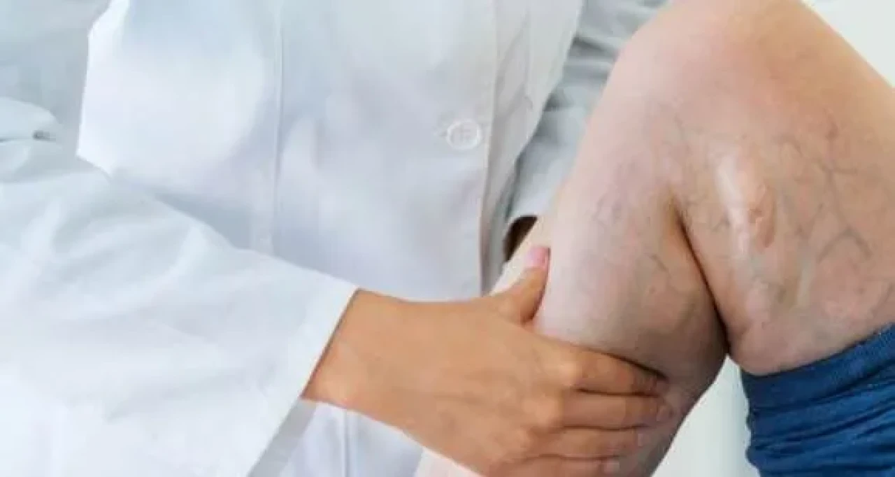 Varis Nedir? Varis Hastalığı Hakkında Detaylı Bilgiler ve Tedavi Yöntemleri