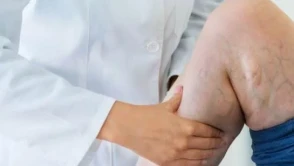 Varis Nedir? Varis Hastalığı Hakkında Detaylı Bilgiler ve Tedavi Yöntemleri