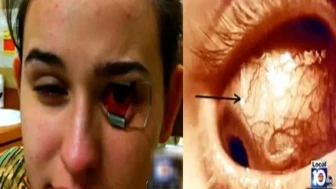 Kontakt lens kullanıcılarına Acanthamoeba keratiti uyarısı: Göz sağlığı için dikkat!