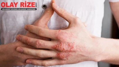 Egzama Nedir, Nasıl Geçer?