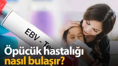 Öpücük Hastalığı Nasıl Bulaşır ? Öpücük Hastalığı nedir?