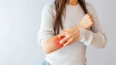 Kontakt Dermatit Nedir? Belirtileri, Türleri ve Tedavi Yöntemleri