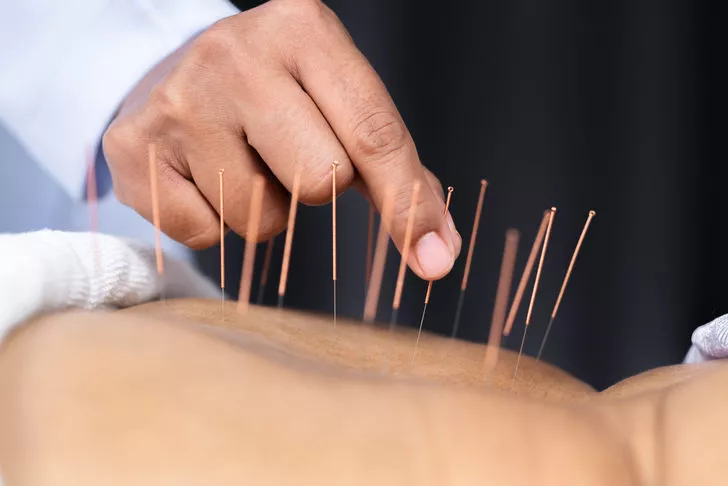 Akupunkturun yan etkileri nelerdir, zararı var mı? Kimlere akupunktur tedavisi uygulanmamalı, baş ağrısı yapar mı?