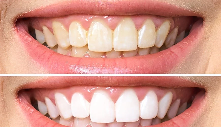 Diyanet açıkladı! Diş beyazlatma işlemi caiz midir?